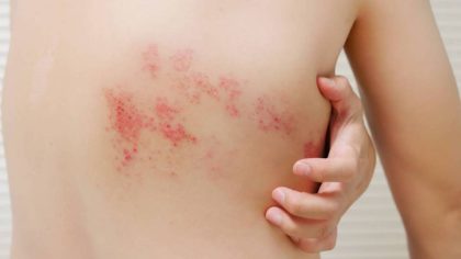 Herpès zoster : les déclencheurs qui provoque la panique et gagne du terrain