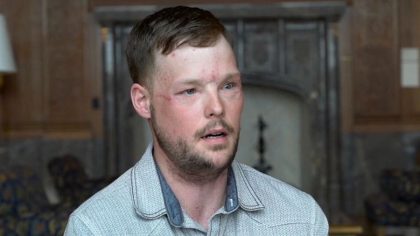 Andrew Sandness : L'avant et l'après de l'homme qui a reçu un nouveau visage