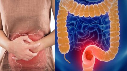Cancer du côlon : symptômes et causes