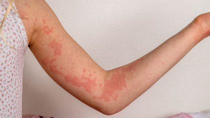 Comment savoir si cette rougeur sur votre peau est une rosacée, une allergie ou une dermatite