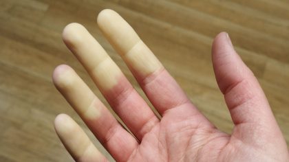 Maladie de Raynaud : symptômes et causes