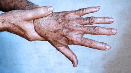 Taches brunes sur la peau : causes, prévention et traitement