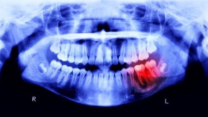Une découverte scientifique révèle que la cause de la maladie d'Alzheimer pourrait provenir de votre bouche
