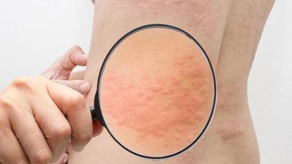 Allergie au stress : quand les émotions déclencher une réponse inattendue