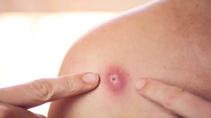 Folliculite : Symptômes et causes