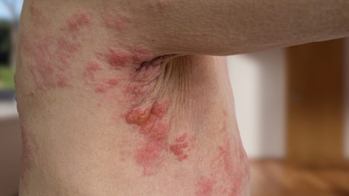 Herpès zoster : qu'est-ce que c'est, symptômes, diagnostic et traitement