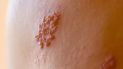 Herpès zoster : qu'est-ce que c'est, symptômes, diagnostic et traitement