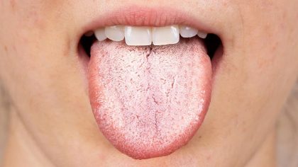 Langue blanche, causes et traitement