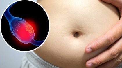 Les symptômes discrets du cancer de l'ovaire