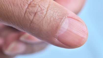 Lignes des ongles : ce que les lignes verticales ou horizontales signifient pour votre santé