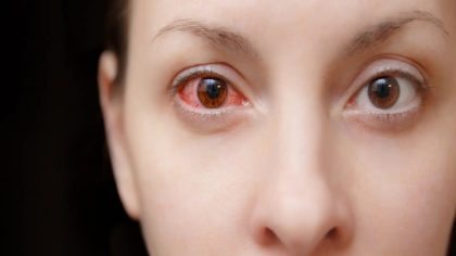 Maladies et affections oculaires : causes, symptômes et traitement