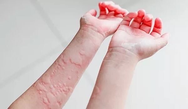 Mon enfant a de l'urticaire. L’urticaire est-elle la même chose que les allergies ?