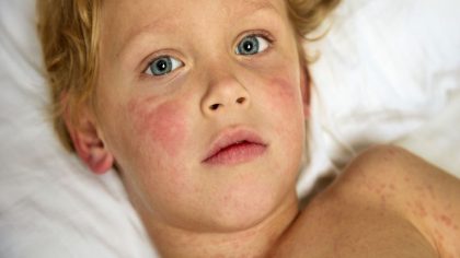 Mon enfant a de l'urticaire. L’urticaire est-elle la même chose que les allergies ?