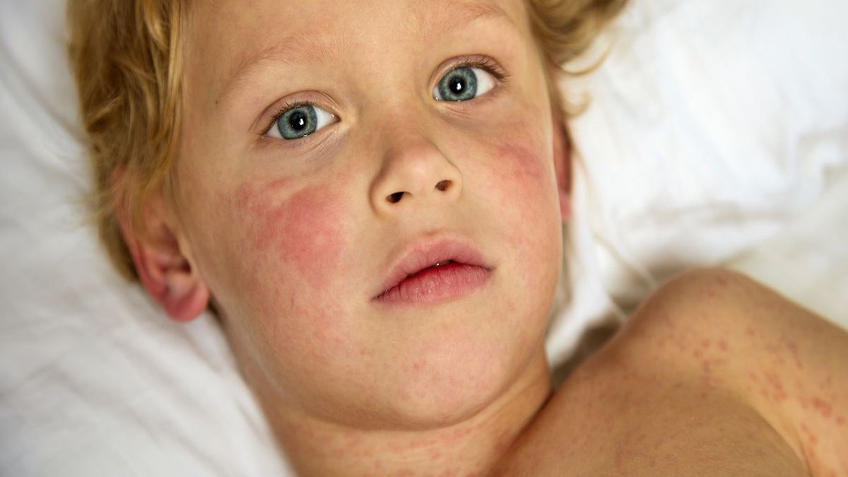 Mon enfant a de l'urticaire. L’urticaire est-elle la même chose que les allergies ?