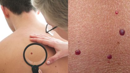 Points rouges sur la peau : découvrez ce qu'ils révèlent et leur impact sur votre santé