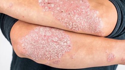 Psoriasis : symptômes, causes et traitements