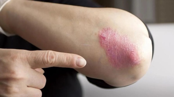 Psoriasis : symptômes, causes et traitements