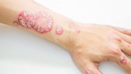Psoriasis : symptômes, causes et traitements
