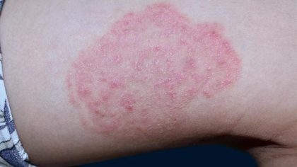 Teigne du corps : causes, symptômes, traitements et comment l'identifier