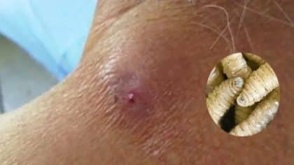 Vers qui poussent sous la peau et autres parasites qui infectent les humains