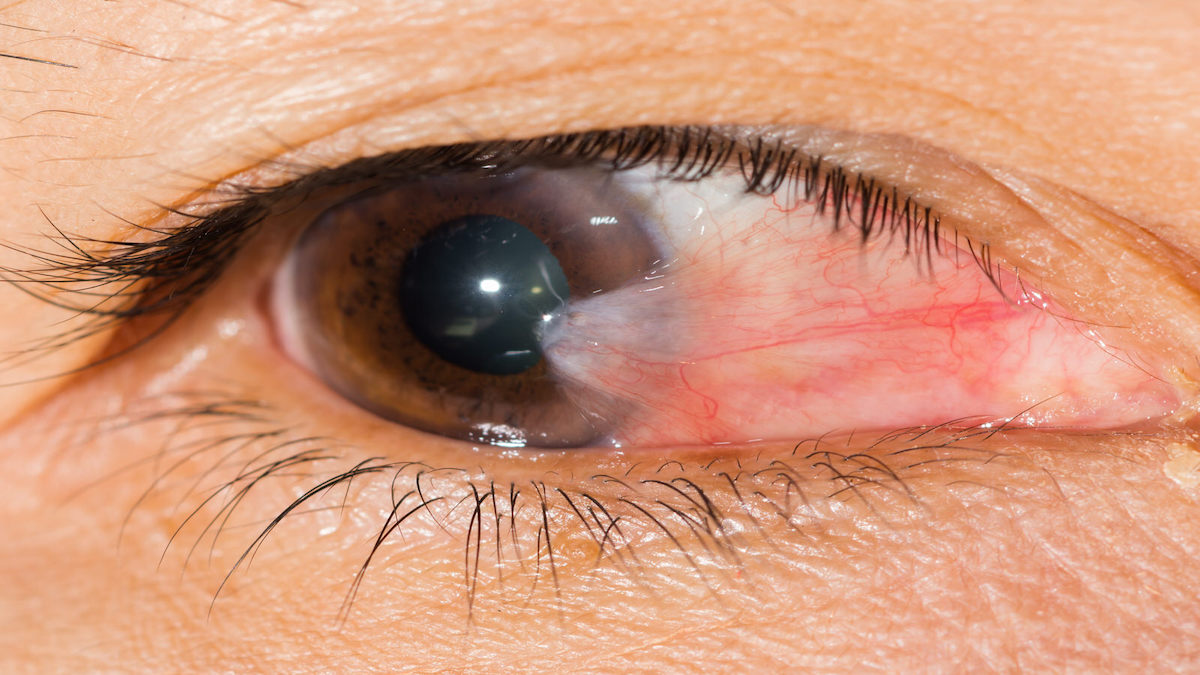 Yeux charnus (Ptérygion) : causes, symptômes et traitements