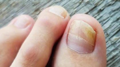 10 remèdes maison contre les mycoses des ongles