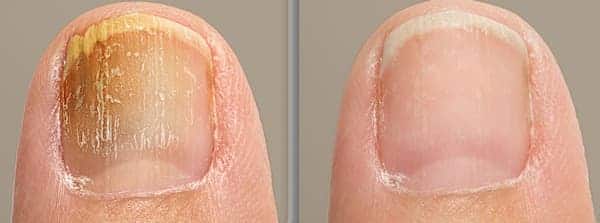 10 remèdes maison contre les mycoses des ongles