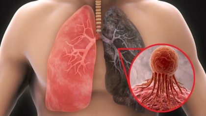 10 signes silencieux du cancer du poumon que vous ne devriez pas ignorer