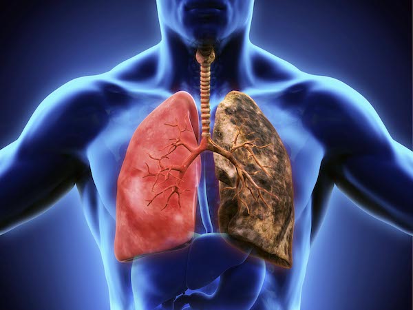 10 signes silencieux du cancer du poumon que vous ne devriez pas ignorer
