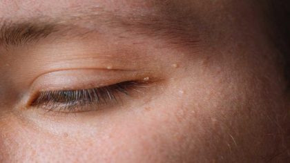 6 techniques naturelles pour retirer les grains de milium autour des yeux