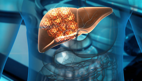 8 signes silencieux du cancer du foie que tout le monde ignore