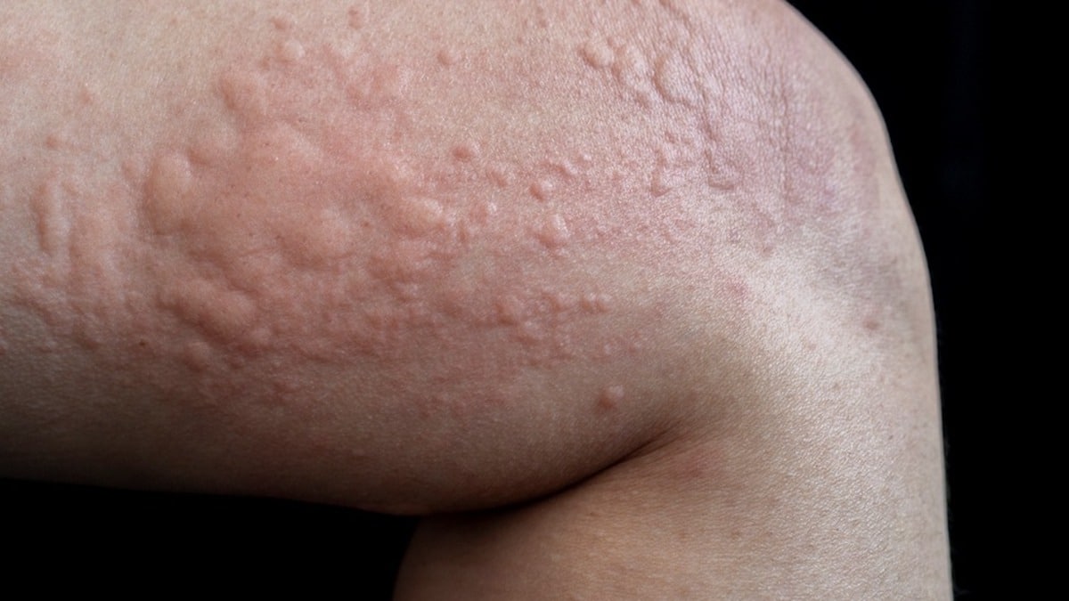 Comment différencier la dermatite atopique des allergies