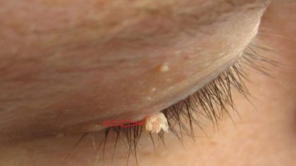 Herpès oculaire : causes, symptômes et traitement