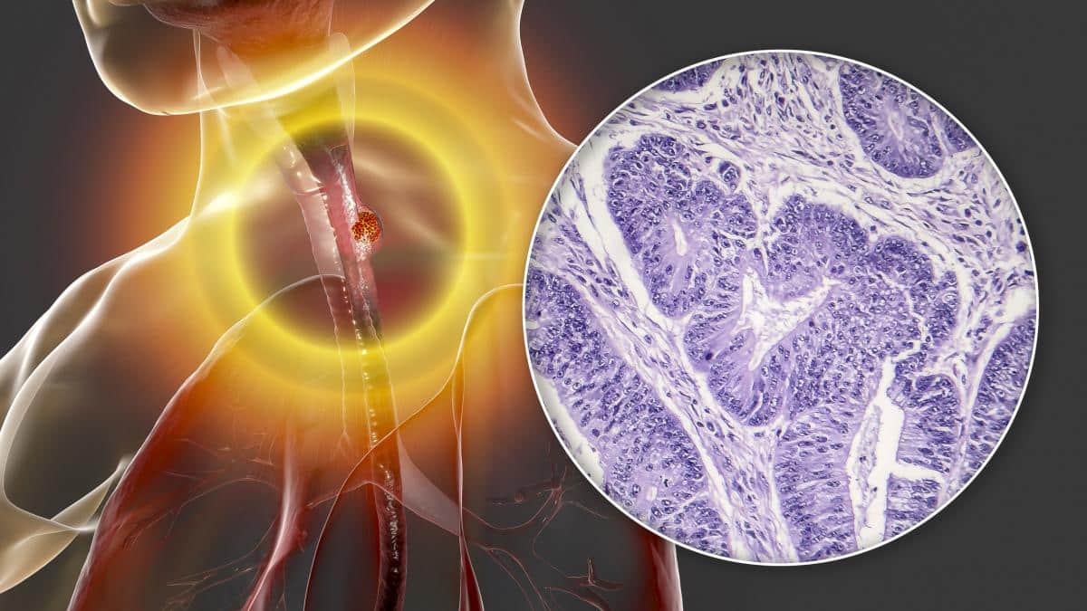 Quels sont les symptômes du cancer de l’œsophage et pourquoi ne devrions-nous pas les ignorer ?
