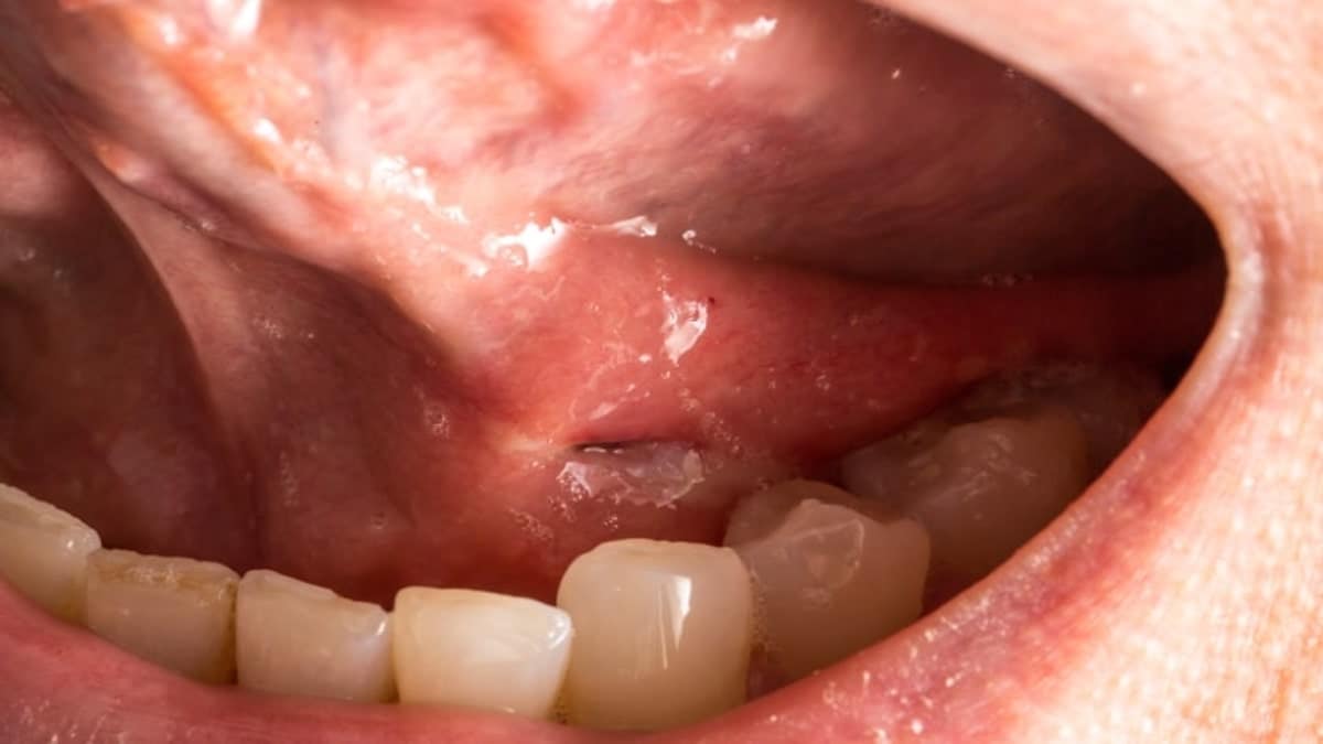 Cancer de la bouche : symptômes et causes