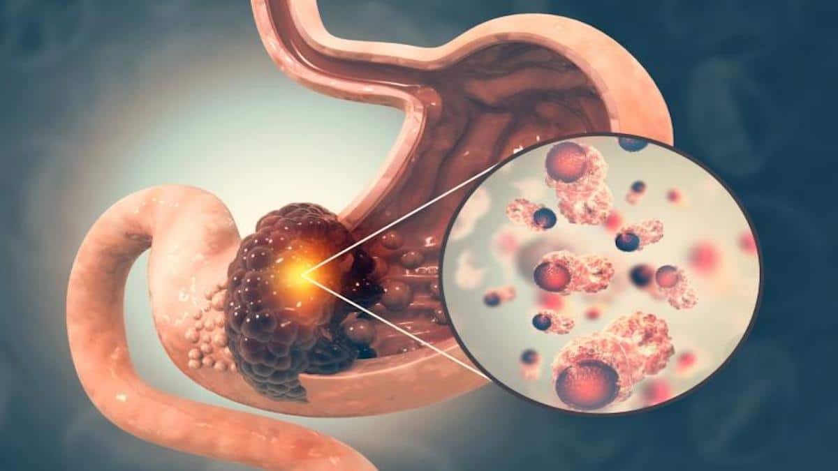 Cancer de l'estomac ou de la gastrie : symptômes, causes et traitement