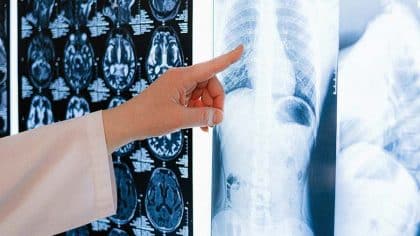 Cancer des os : symptômes et causes