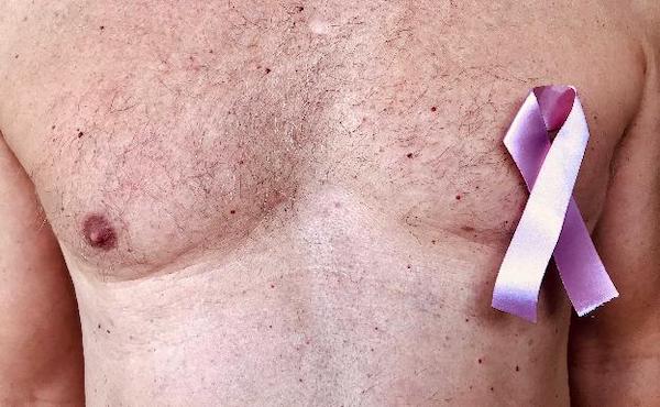 Cancer du sein chez l'homme : symptômes