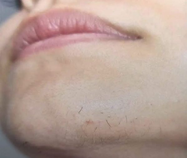 Causes de la pilosité faciale excessive ou indésirable chez les femmes