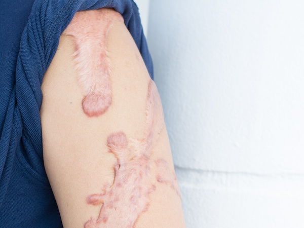 Cicatrices chéloïdes : symptômes et traitements