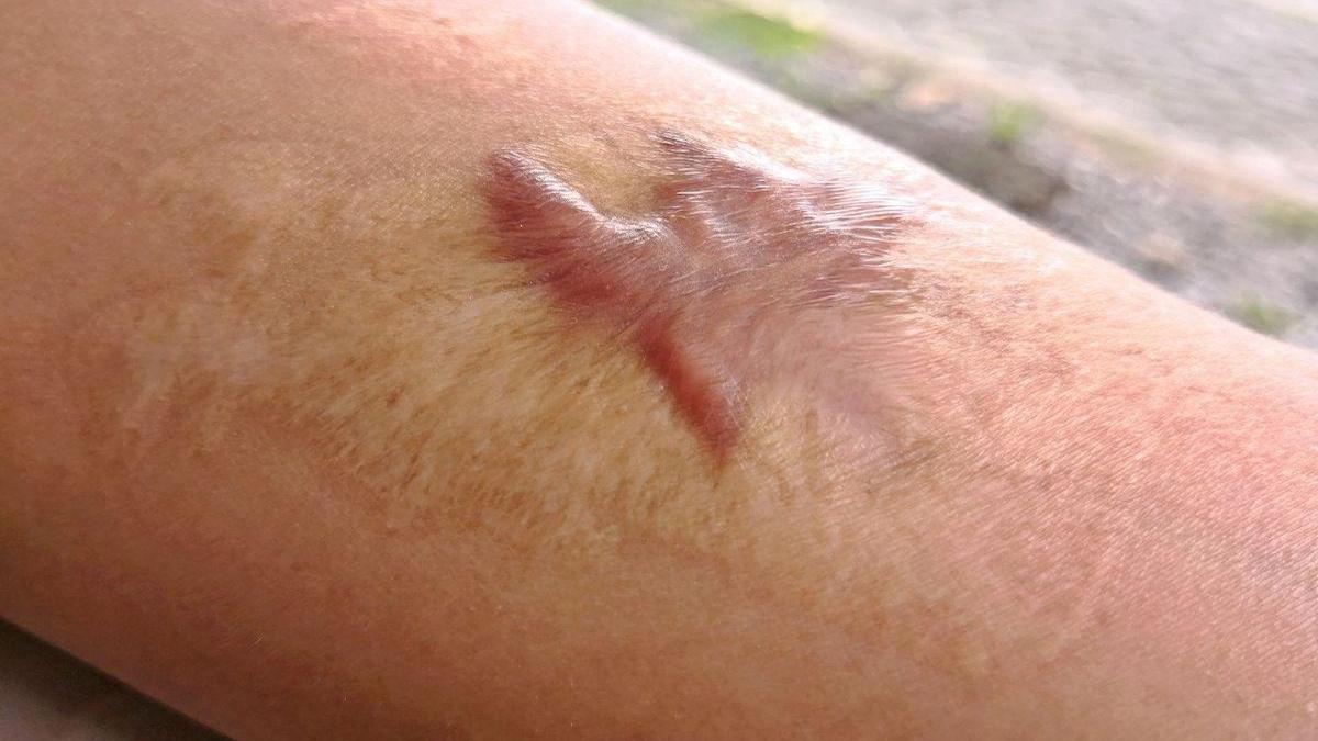 Cicatrices chéloïdes : symptômes et traitements