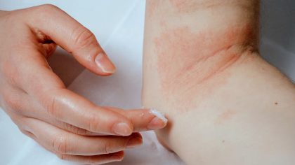 Comment différencier la dermatite atopique des allergies