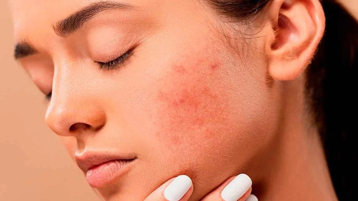 Comment différencier la dermatite atopique des allergies