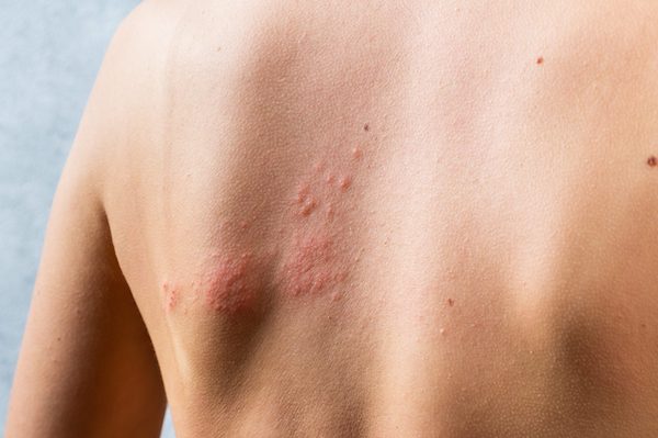 Comment différencier la dermatite atopique des allergies