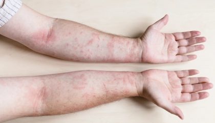 Comment différencier la dermatite atopique des allergies