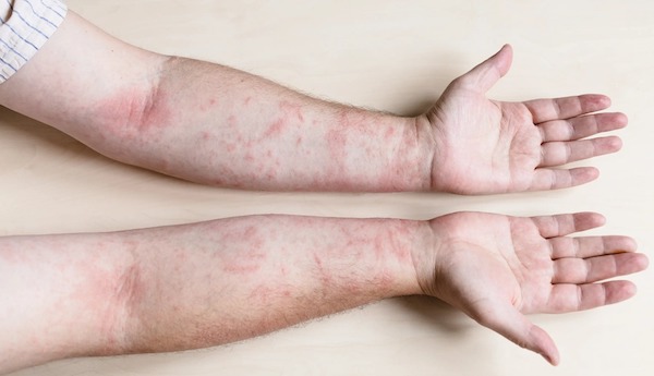 Comment différencier la dermatite atopique des allergies