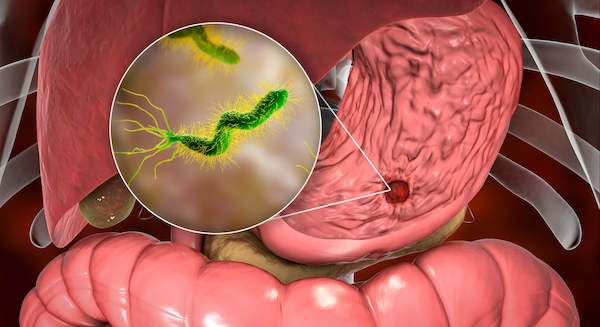 Comment se transmet la bactérie liée au cancer de l'estomac
