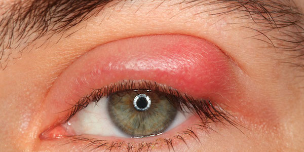 Infections oculaires : les dangers de dormir avec ses lentilles de contact