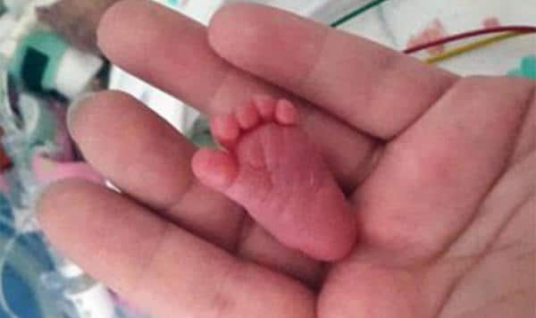 Curtis, le bébé le plus prématuré du monde : né aux États-Unis à 21 semaines de grossesse, pesant 420 grammes