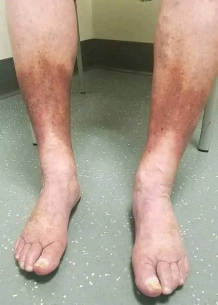 Dermatite de stase : symptômes, causes et traitement
